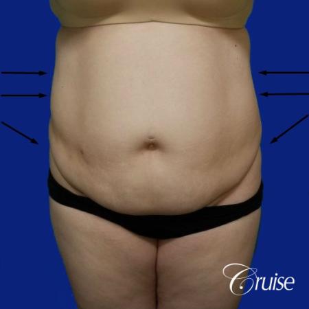 Best liposuction procedures dr cruise - Before Image 1
