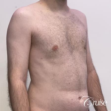 Gynecomastia: Patient 128 - After 5