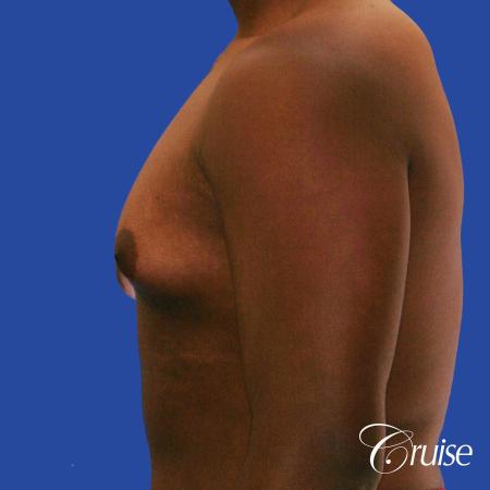 male breast moderate gynecomastia on young teen - Before Image 2