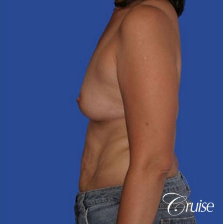 best mini mommy makeover with silicone breast implants - Before and After Image 2