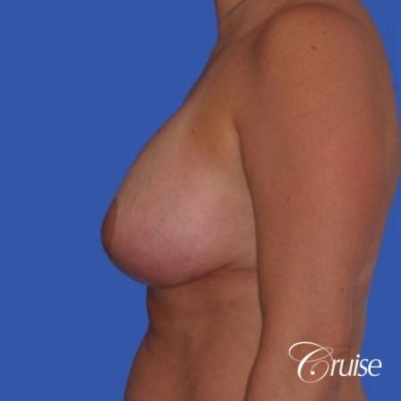 best breast lift anchor results in Orange County on 38 yr old - After Image 2
