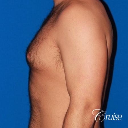 moderate gynecomastia on adult - Before 2