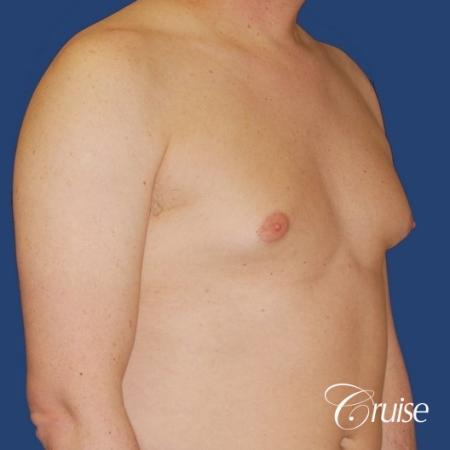moderate gynecomastia on adult donut lift - Before and After Image 4