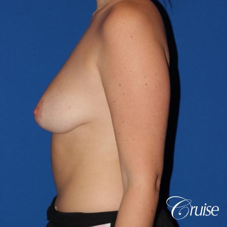silicone implants with breast lift anchor newport beach - Before and After Image 2
