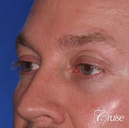 male soft tissue filler Juvaderm - Before Image 2