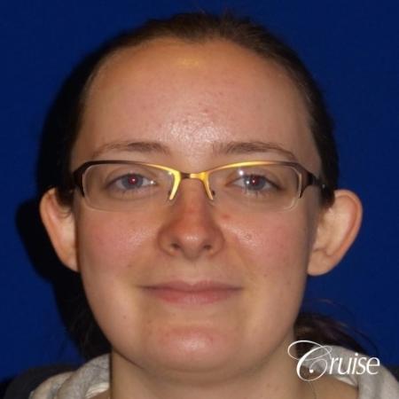 Otoplasty And Earlobe Repair: Patient 2 - Before Image 1