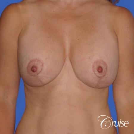 best saline breast reduction - After Image 1