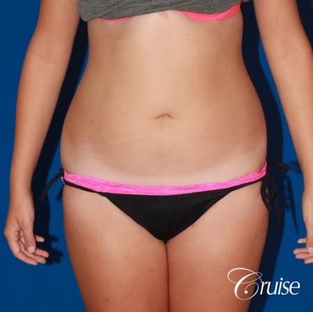 liposuction love handles and tummy - Before Image 1