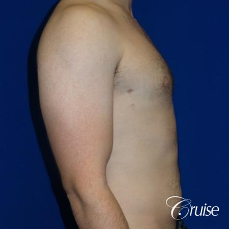 Adult gynecomastia before and after photos - After Image 3