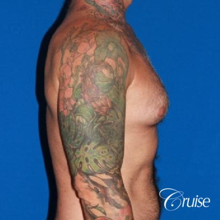 Moderate Gynecomastia -Areola Incision - Before Image 3