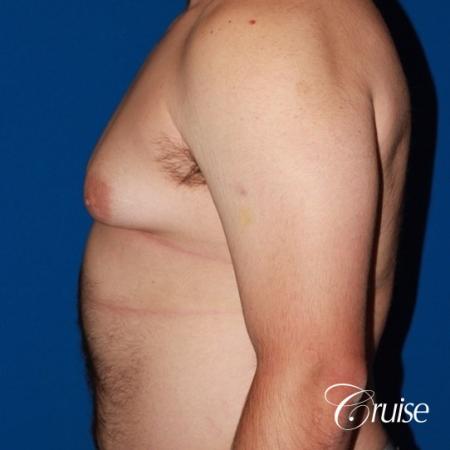 Free Nipple Graft male gynecomastia - Before and After Image 2