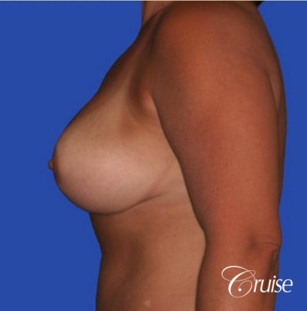 best pictures of breast lift anchor on 38 yr old mother - After Image 2