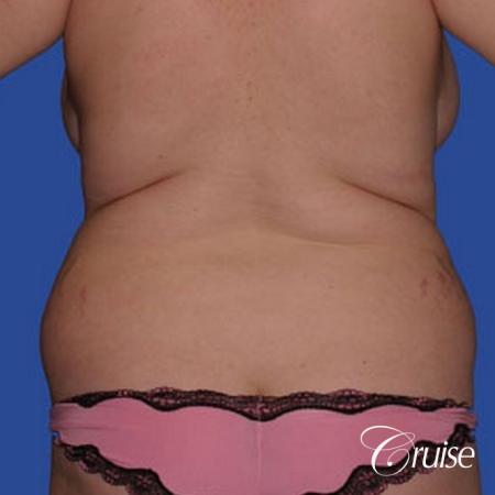 best before and after of liposuction abdomen, flanks, and upper back - Before Image