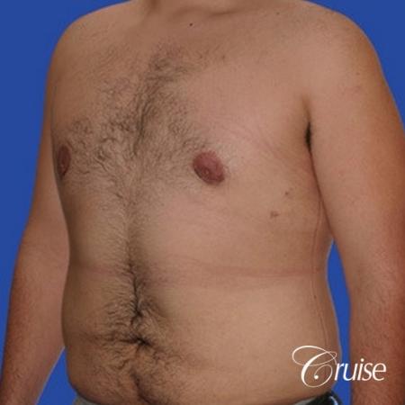moderate gynecomastia with pointy nipples male - After Image 2