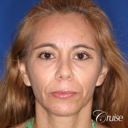 Fat Transfer - Tear Trough, Forehead, Upper Lids, Cheeks - After Image