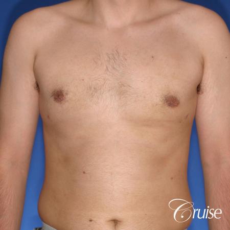 moderate gynecomastia puffy nipple - After Image 1