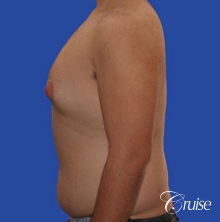 male liposuction abdomen flanks with Gynecomastia - Before Image 4