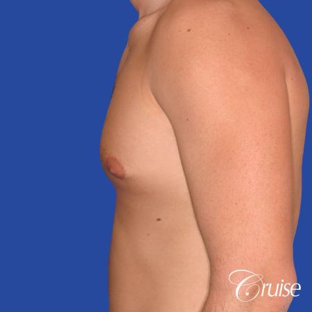24 yr old body builder mild gynecomastia - Before Image 2