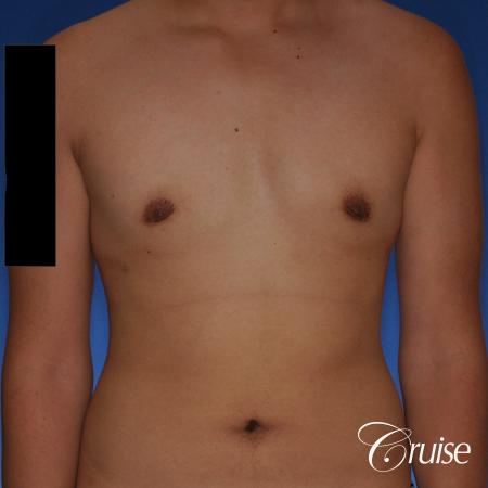 best gynecomastia surgery with plastic surgeon, Dr. Cruise - After Image 1