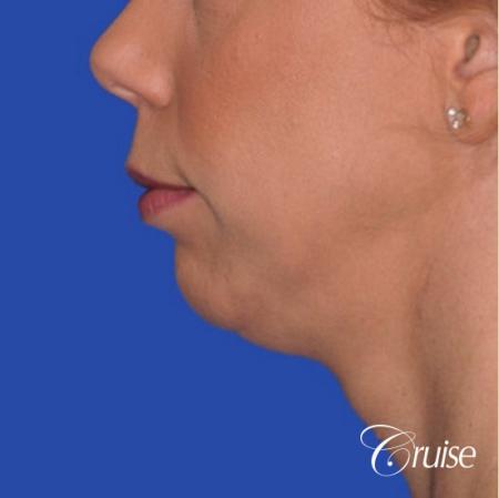 best medium anatomic chin implant on female - Before Image 2