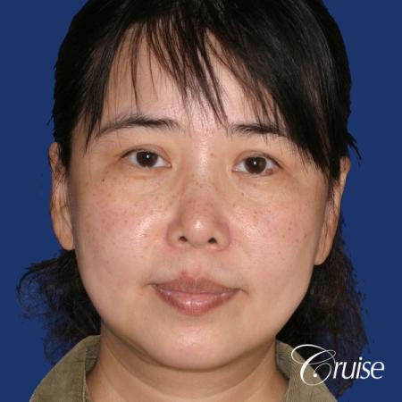 best chin implant photos with large implant - After Image 1