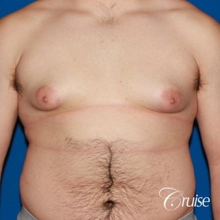 20 with Gynecomastia and puffy nipple - Before Image 1