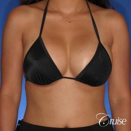 Breast Augmentation - After Image 4