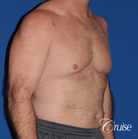 extended pa incision on gynecomastia patient - Before and After Image 3