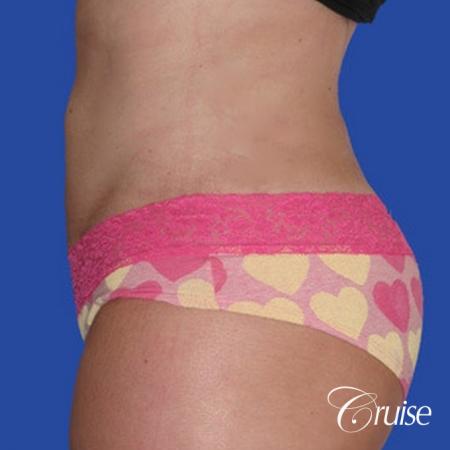 Liposuction: Patient 25 - After Image 2