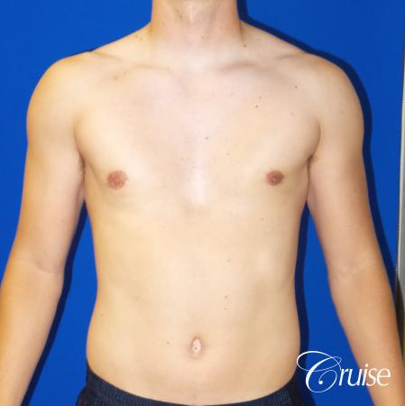 Best moderate gynecomastia on male adult - After Image 1