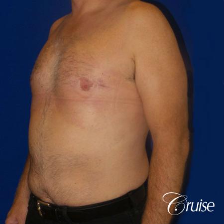 gynecomastia surgery results - After Image 2