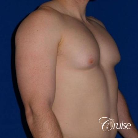 Dr. Cruise gynecomastia surgery photos - Before and After Image 2