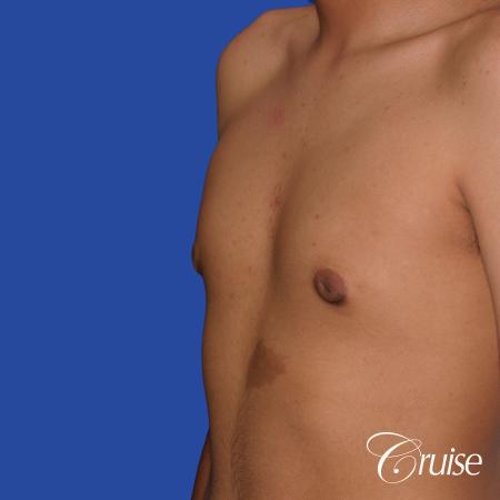 gynecomastia patient gets nipple reduction for best results - After Image 3
