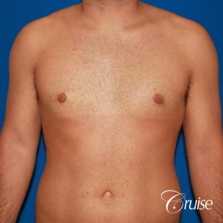 moderate gynecomastia on adult - After 1