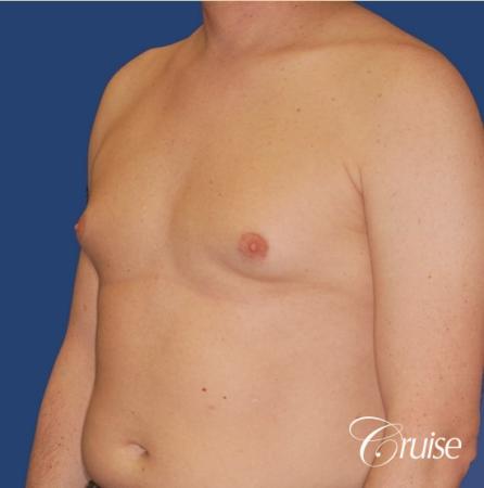 moderate gynecomastia on adult donut lift - Before Image 3