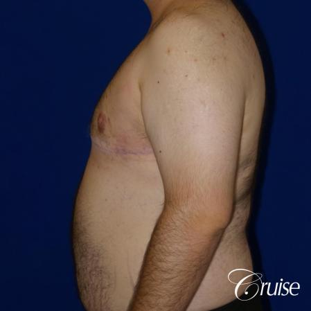 gynecomastia with free nipple graft - 1 After Image 3