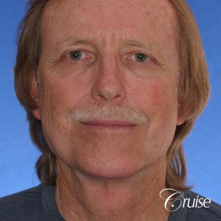 62 yr old with medium square chin augmentation - After Image 1