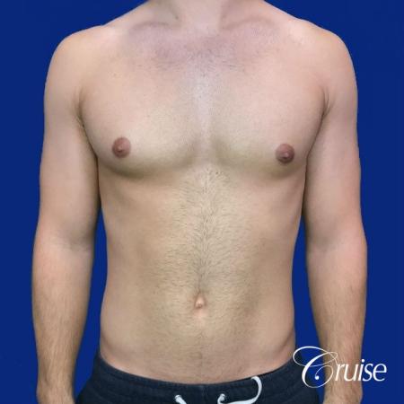 gynecomastia correction newport beach - Before 1