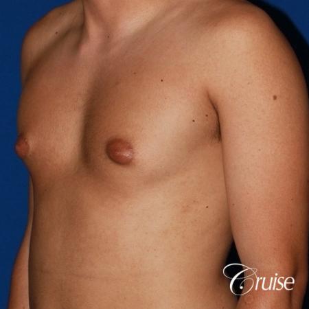 mild gynecomastia before and after with puffy nipple - Before and After Image 3