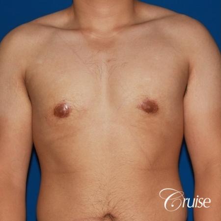 puffy nipple male breast on young adult - After Image 1