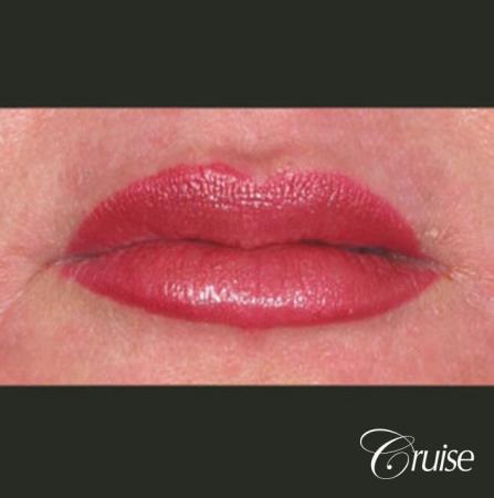 best filler pictures in Newport Beach - After Image 1