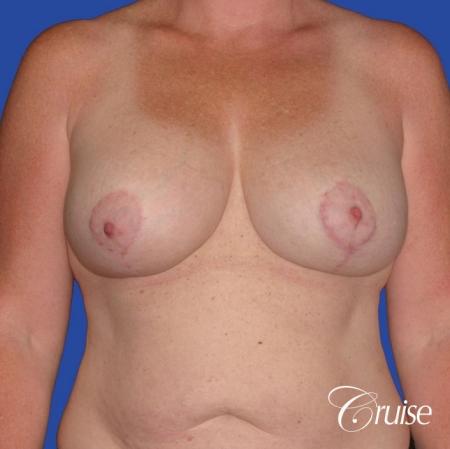 capsular contracture before and after pictures in Newport Beach - After 1