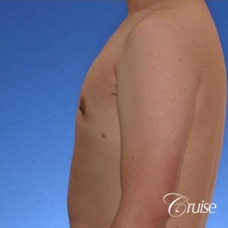 young male with mild gynecomastia surgery for puffy nipple - After Image 2