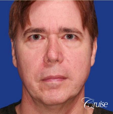 male with best scar for chin implant - Before Image 1