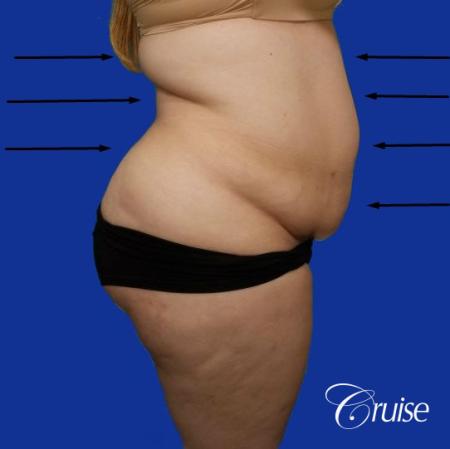 Best liposuction procedures dr cruise - Before and After Image 4