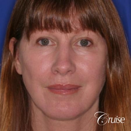 52 year old with chin augmentation and facelift - After Image 1