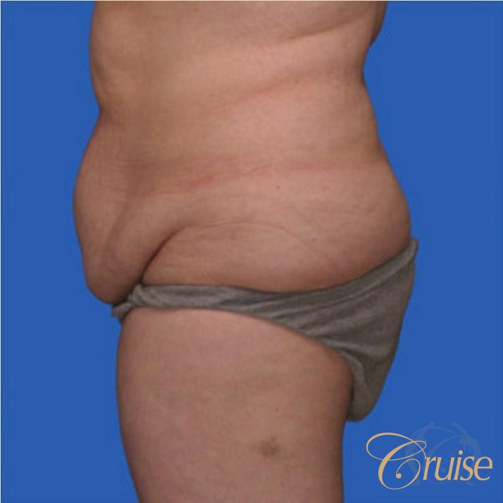 best extended abdominoplasty incision - Before and After 2