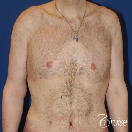severe weight loss gynecomastia upper body lift - 1 After Image 1