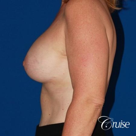 best anchor breast lift with specialist and plastic surgeon - After Image 2