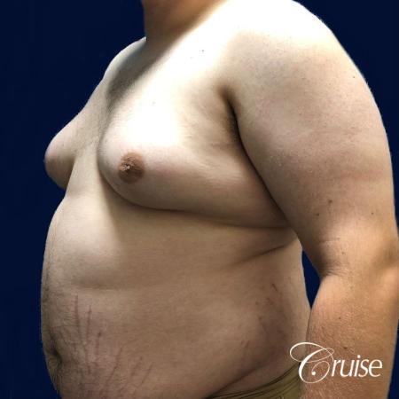 male breast reduction surgery orange county - Before and After 3